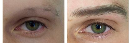 lopécie universalis des sourcils avant et après dermopigmentation