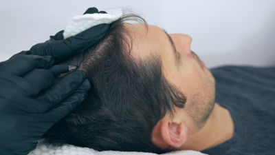 Homme réalisant une Micropigmentation Scalp pour camoufler un début de calvitie