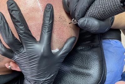 La micropigmentation et la greffe de cheveux ont chacune leurs sp&eacute;cificit&eacute;s