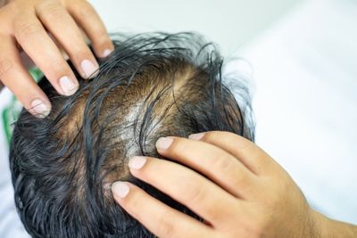 La perte de densit&eacute; capillaire peut toucher aussi bien les hommes que les femmes