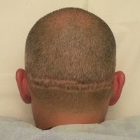 La tricopigmentation pour camoufler les cicatrices du cuir chevelu