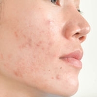 Traiter l’acné en réalisant un peeling avec les produits PCA Skin