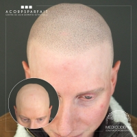 Alopécie universelle :  retrouver une vie normale grâce au maquillage permanent