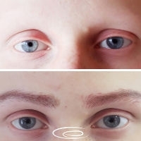 Tricopigmentation et dermopigmentation : comment les techniques esthétiques font oublier l’alopécie universelle