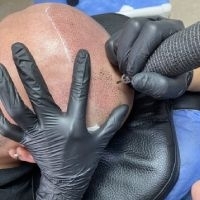 Micropigmentation ou greffe de cheveux : quelle technique choisir ?