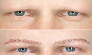 Traitement de l'alopécie universelle par dermopigmentation