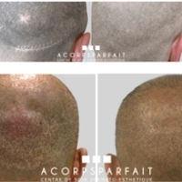 Camoufler une cicatrice après une greffe de cheveux grâce à la tricopigmentation