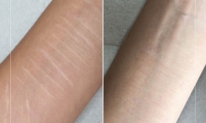 Camouflage de cicatrices, vergetures et vitiligo