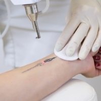 Quels résultats attendre d’un détatouage laser ? 