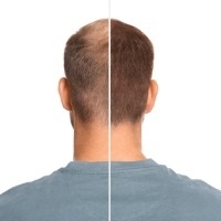 Comment se déroule une procédure de micropigmentation capillaire pour camoufler une alopécie ? 